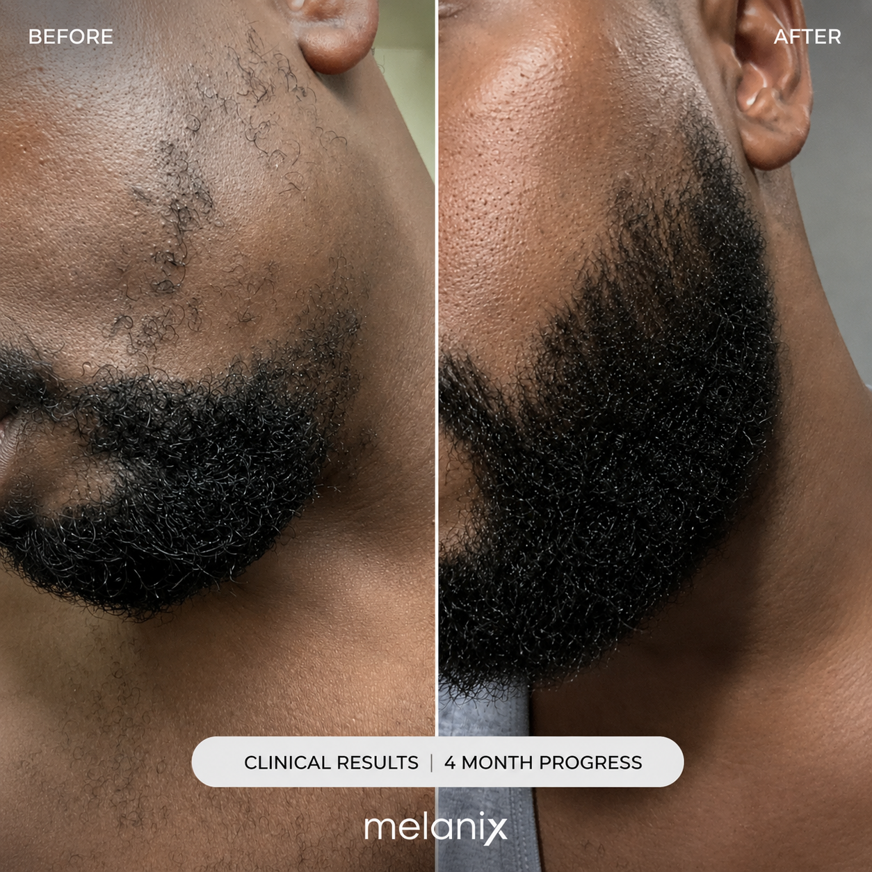 Beard Regrowth Adenosine & GHK-Cu Micro-Infusion System
