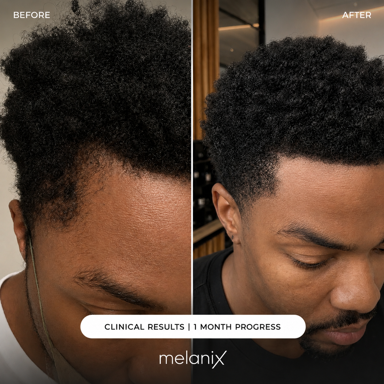 Hair Regrowth 2.0 Adenosine & GHK-Cu Micro-Infusion System