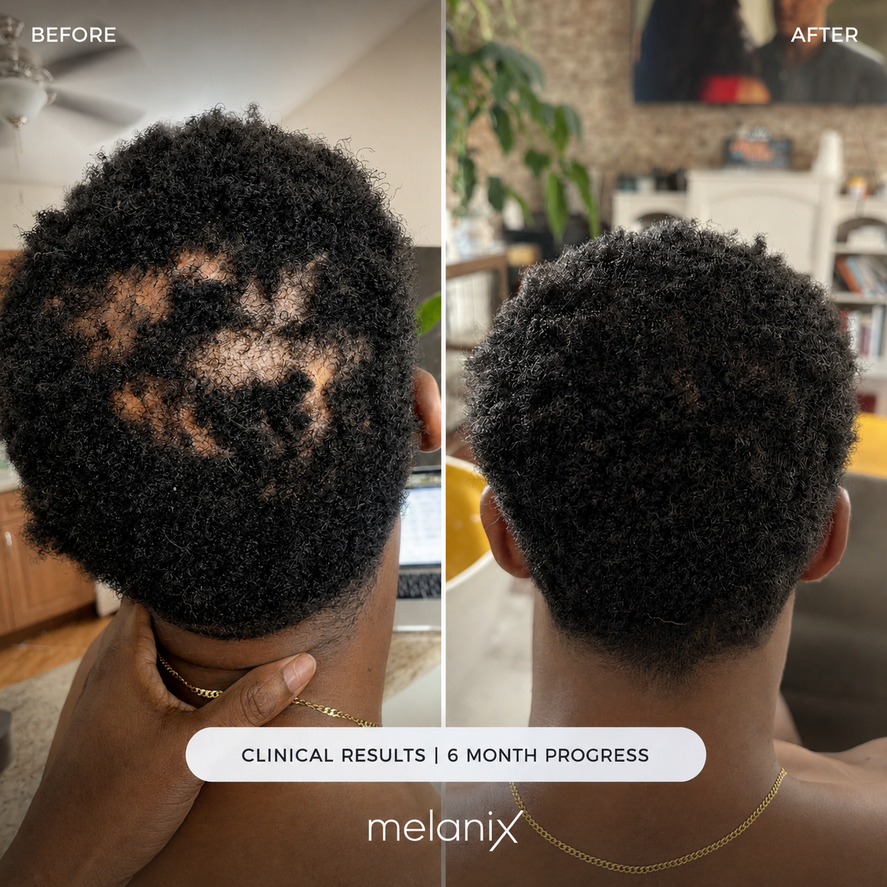 Hair Regrowth 2.0 Adenosine & GHK-Cu Micro-Infusion System