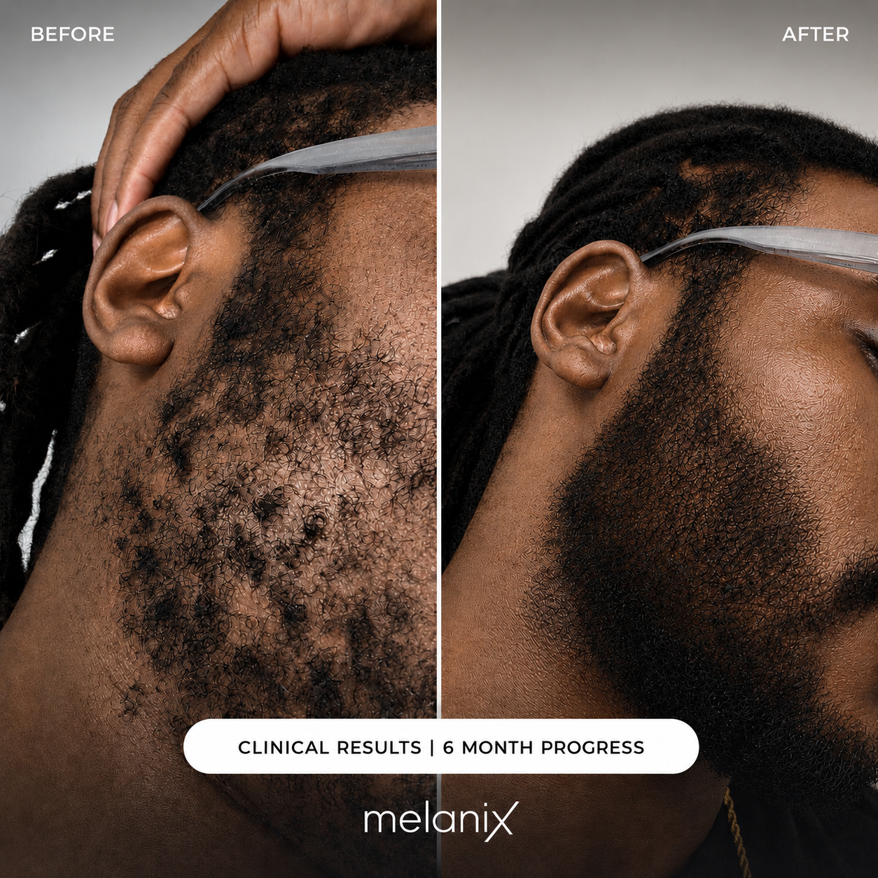 Hair Regrowth 2.0 Adenosine & GHK-Cu Micro-Infusion System